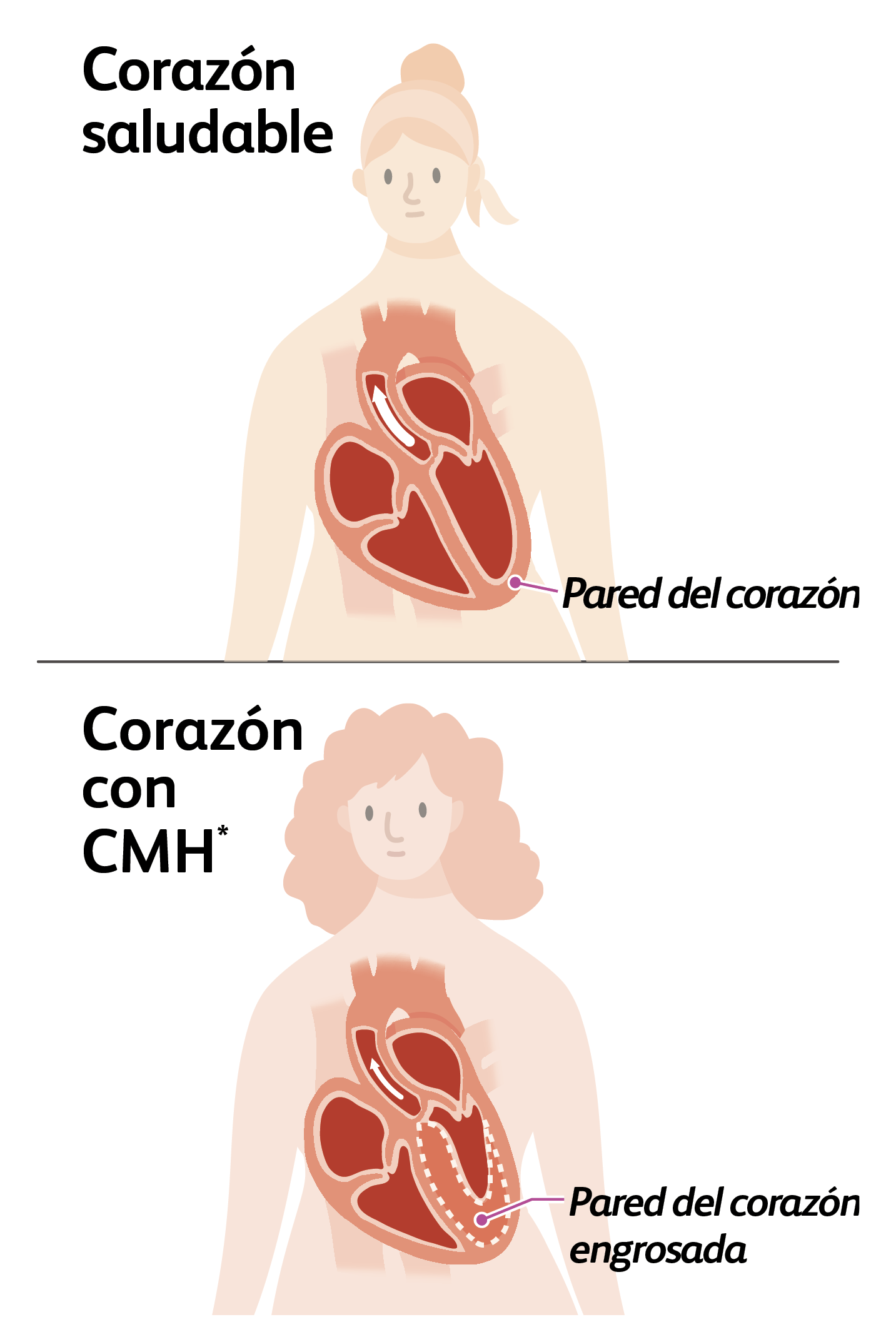 Illustration of a person with a healthy heart and a normal heart wall and a person with a heart with hypertrophic cardiomyopathy (HCM) and a thickened heart wall