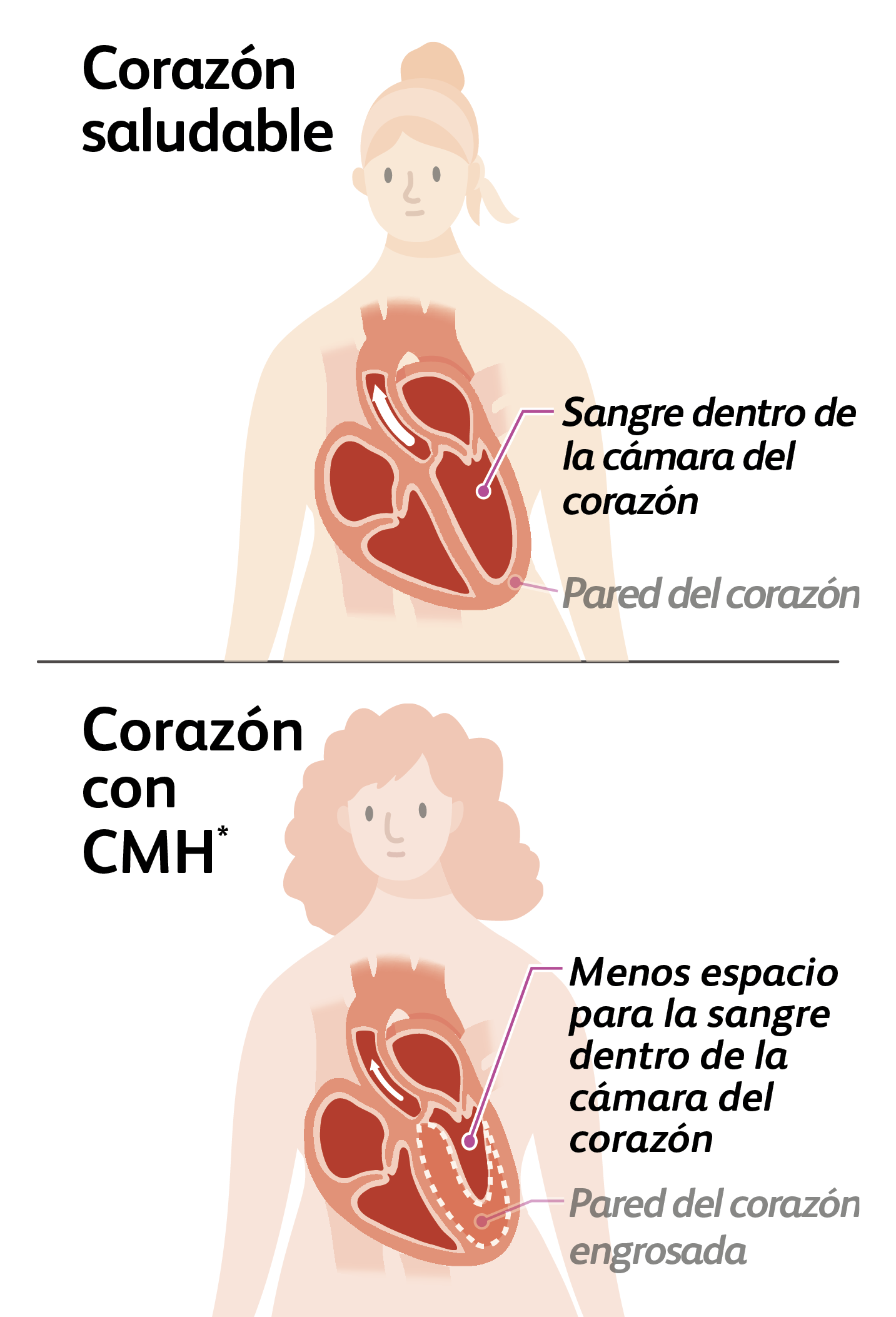 Illustration of a person with a healthy heart and a normal heart chamber and a person with a heart with hypertrophic cardiomyopathy (HCM) and less room for blood within their heart chamber