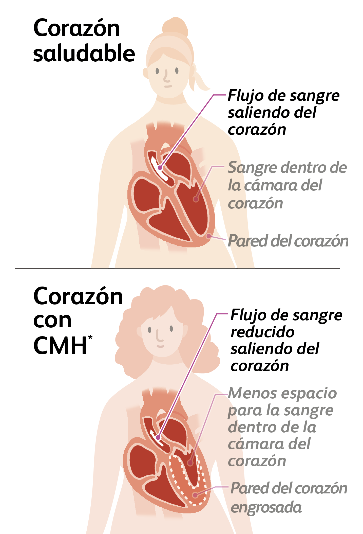 Illustration of a person with a healthy heart and normal blood flow out of the heart and a person with a heart with hypertrophic cardiomyopathy (HCM) and reduced blood flow out of the heart