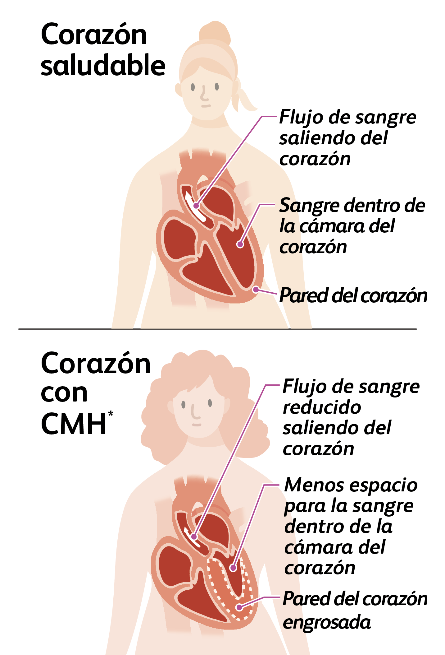 Illustration of a person with a healthy heart and a person with a heart with hypertrophic cardiomyopathy (HCM)