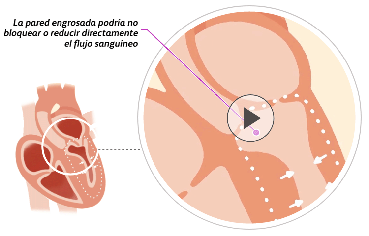 Illustration of a heart with non-obstructive hypertrophic cardiomyopathy (HCM)