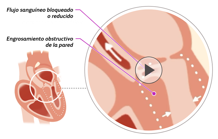 Illustration of a heart with obstructive hypertrophic cardiomyopathy (oHCM)