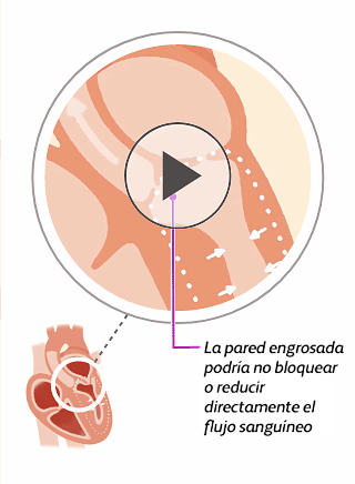 Illustration of a heart with non-obstructive hypertrophic cardiomyopathy (HCM)