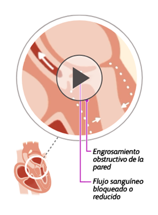 Illustration of a heart with obstructive hypertrophic cardiomyopathy (oHCM)