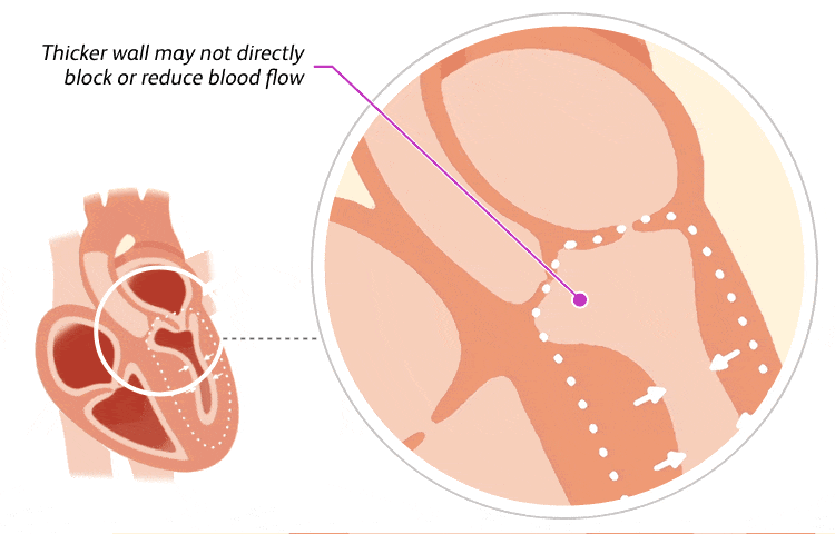 Illustration of a heart with non-obstructive hypertrophic cardiomyopathy (HCM)