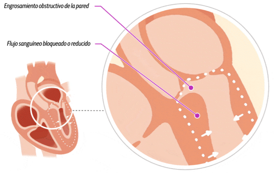 Illustration of a heart with obstructive hypertrophic cardiomyopathy (oHCM)