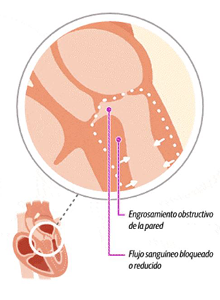 Illustration of a heart with obstructive hypertrophic cardiomyopathy (oHCM)