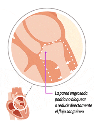 Illustration of a heart with non-obstructive hypertrophic cardiomyopathy (HCM)