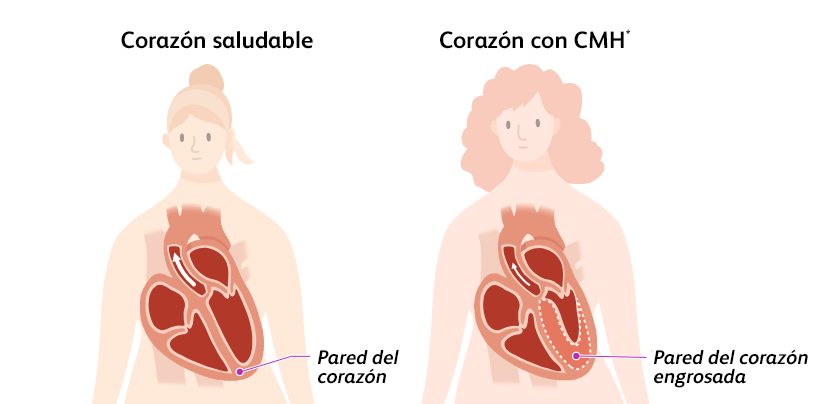 Illustration of a person with a healthy heart and a normal heart wall and a person with a heart with hypertrophic cardiomyopathy (HCM) and a thickened heart wall