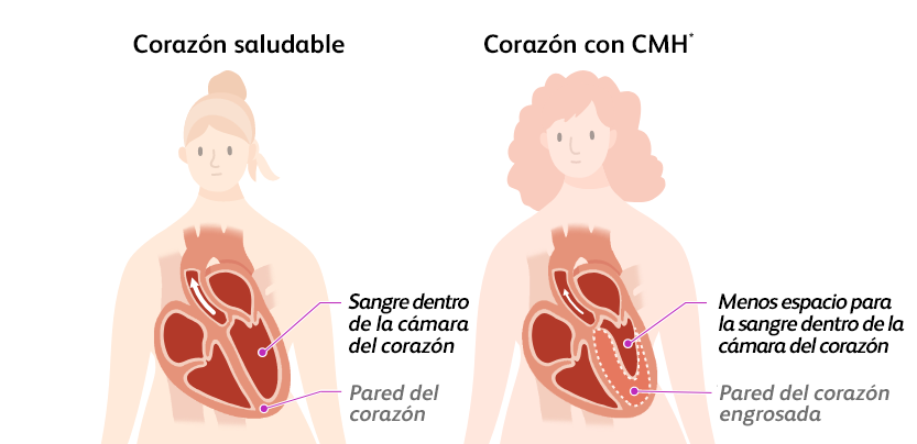 Illustration of a person with a healthy heart and a normal heart chamber and a person with a heart with hypertrophic cardiomyopathy (HCM) and less room for blood within their heart chamber