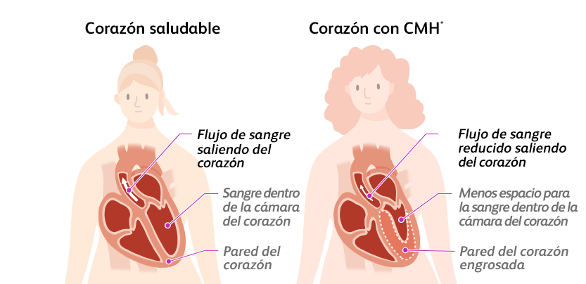 Illustration of a person with a healthy heart and normal blood flow out of the heart and a person with a heart with hypertrophic cardiomyopathy (HCM) and reduced blood flow out of the heart