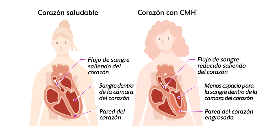 Illustration of a person with a healthy heart and a person with a heart with hypertrophic cardiomyopathy (HCM)